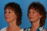 Facial Rejuvenation: 52-Year-Old Woman