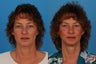 Facial Rejuvenation: 52-Year-Old Woman