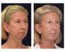 Lower Facial Rejuvenation