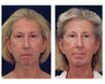 Lower Facial Rejuvenation