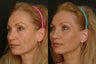 Full Face Fat Transfer