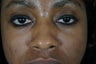 27 year old treated with filler to improve the bags underneath her eyes