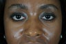 27 year old treated with filler to improve the bags underneath her eyes