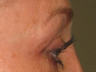 Ulthera