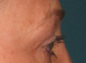 Ulthera
