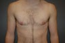 Bilateral keyhole approach with periarolar mastopexy, ( reduction and tightening of nipple/areola with incision around areola).