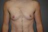Bilateral keyhole approach with periarolar mastopexy, ( reduction and tightening of nipple/areola with incision around areola).