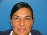 42 yr old woman for Botox