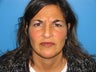 42 yr old woman for Botox