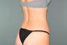 Smart Lipo