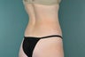 Smart Lipo
