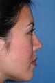 Asian Rhinoplasty