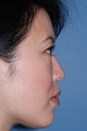 Asian Rhinoplasty