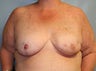 Female patient who underwent breast reconstruction