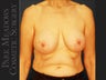 bilateral mastectomy with tissue expanders; silicone implant exchange; nipple reconstruction and areola pigmentation