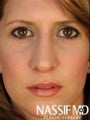 Female Primary Rhinoplasty