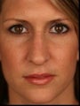 Female Primary Rhinoplasty