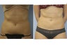 18 Year Old Female - Liposuction