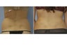 18 Year Old Female - Liposuction