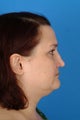 Revision septorhinoplasty