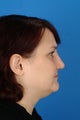 Revision septorhinoplasty