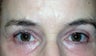 Laser Eye Lid Lift (Laser Blepharoplasty)