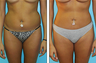 Liposuction Before & After