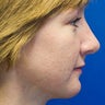 Revision rhinoplasty combined with silicone chin implantation