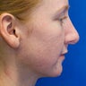 Revision rhinoplasty combined with silicone chin implantation