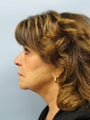 62 Year Old Female Treated with Precision Tx Laser Lift