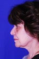 62 Year Old Female Treated with Precision Tx Laser Lift