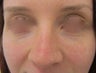 22 year-old female treated with Restylane filler for Tear Trough