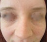 22 year-old female treated with Restylane filler for Tear Trough