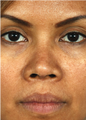 Barrera Rhinoplasty Ethnic Rhinoplasty
