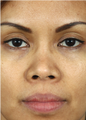 Barrera Rhinoplasty Ethnic Rhinoplasty