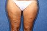 57 Year Old Bilateral Thighplasty