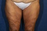 57 Year Old Bilateral Thighplasty