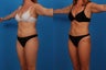 Liposuction: 44-Year-Old Female