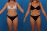 Liposuction: 44-Year-Old Female