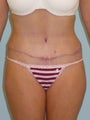 Unfortunate abdominal scarring from inafnt surgery finally gets fixed in adulthoo