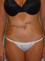 Unfortunate abdominal scarring from inafnt surgery finally gets fixed in adulthoo