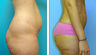 Liposuction Before & After