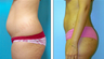 Liposuction Before & After