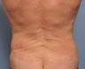 50 Year Old Male Treated For Love Handles