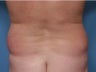 50 Year Old Male Treated For Love Handles