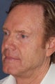 61 year old male treated with fillers
