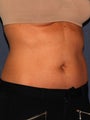 CoolSculpting
