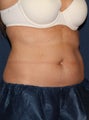 CoolSculpting