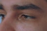 Dark Circles Under Eyes Before and After Restylane