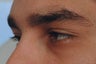 Dark Circles Under Eyes Before and After Restylane